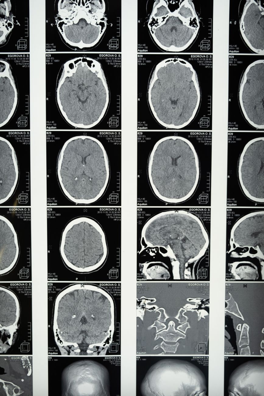 Comprehensive brain MRI scans showing the autonomic nervous system pathways. Sympathetic, parasympathetic and enteric nervous system explained - Recalibrate neuroscience blog.