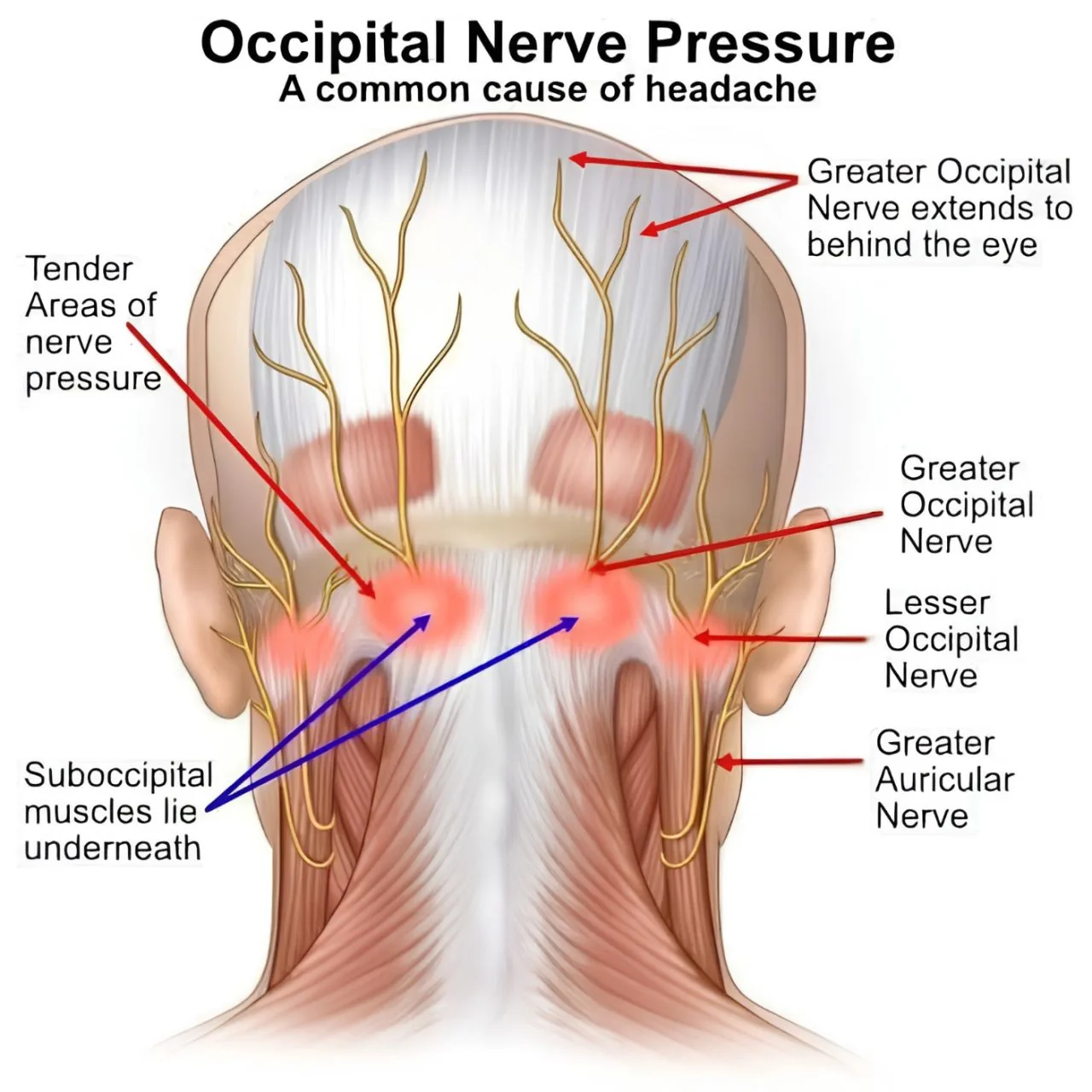 Anatomical illustration of the back of the head and neck showing occipital nerve pressure - the greater occipital nerve extending forward to behind the eye, the lesser occipital and greater auricular nerves, tender areas of nerve pressure highlighted in red, and the suboccipital muscles lying underneath. Recalibrate pain science blog.